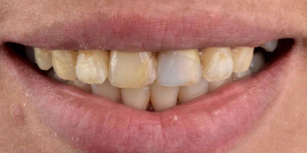 Before Image