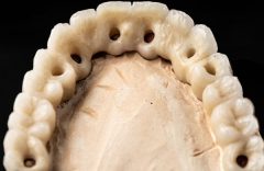 Implant