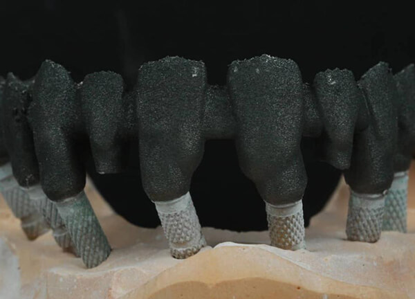 PFM/Non Precious – Screw Retained