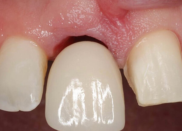 Zircon – Screw-Retained